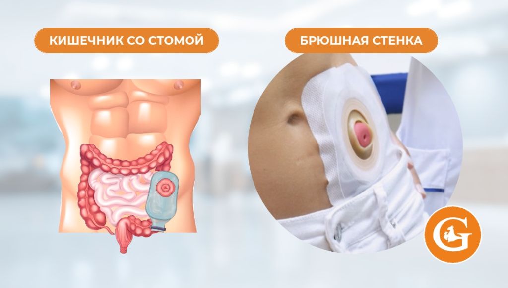 Колостомия