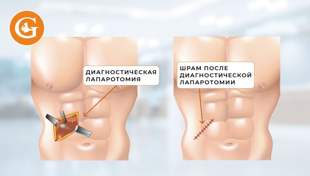 Лапаротомия диагностическая