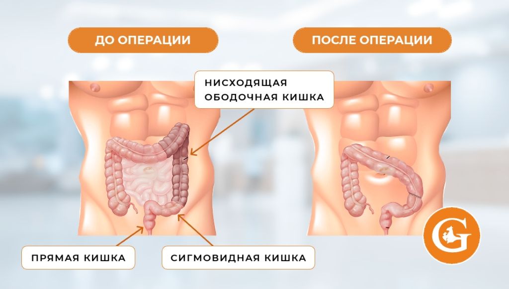 Левосторонняя гемиколэктомия