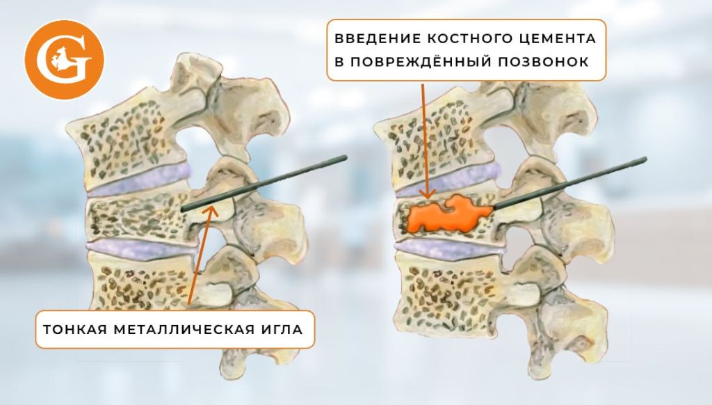 Вертебропластика
