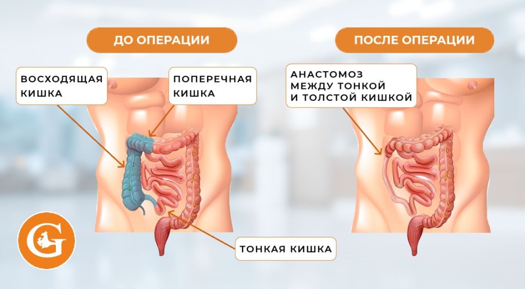 Гемиколэктомия правосторонняя