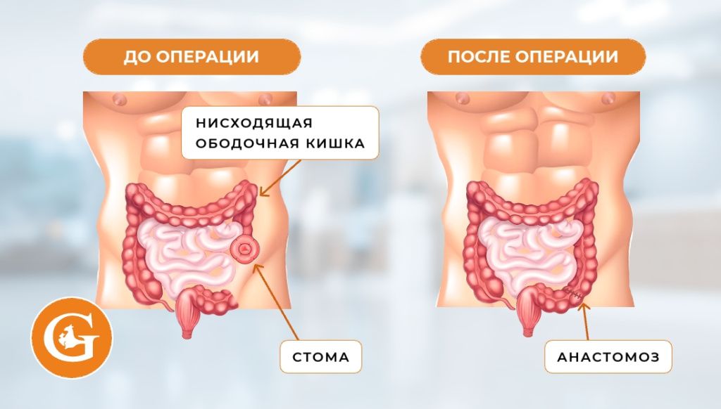 Гемиколэктомия левосторонняя с формированием колостомы