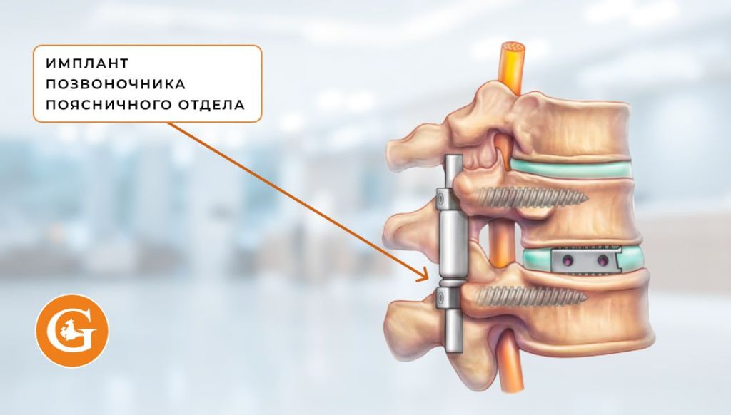 Импланты в позвоночнике