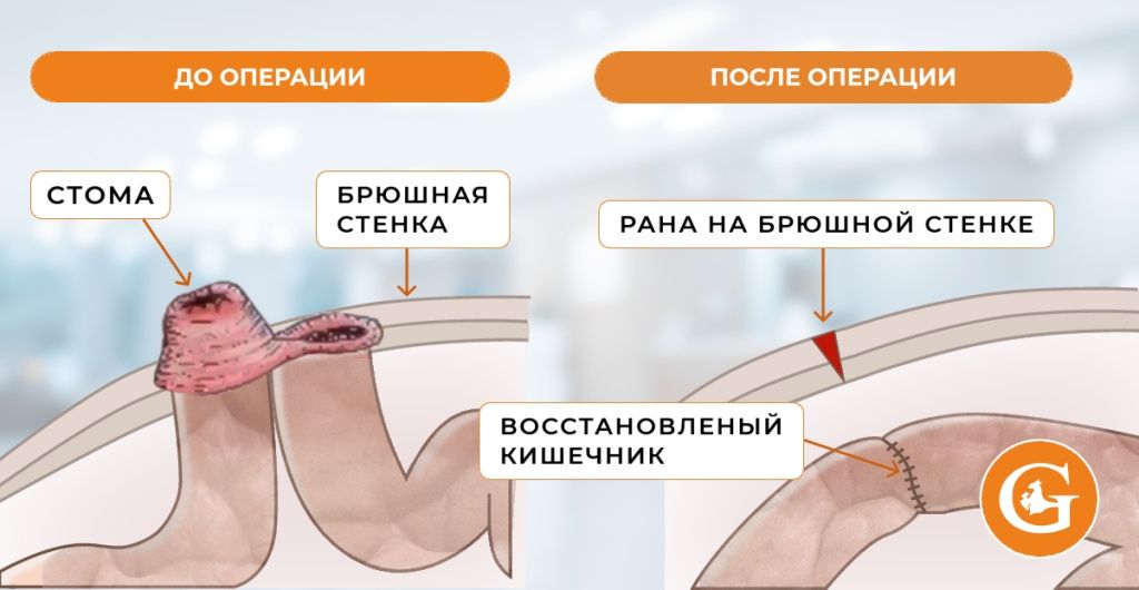 Закрытие колостомы