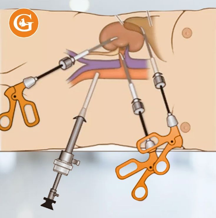 Лапароскопическая резекция почки