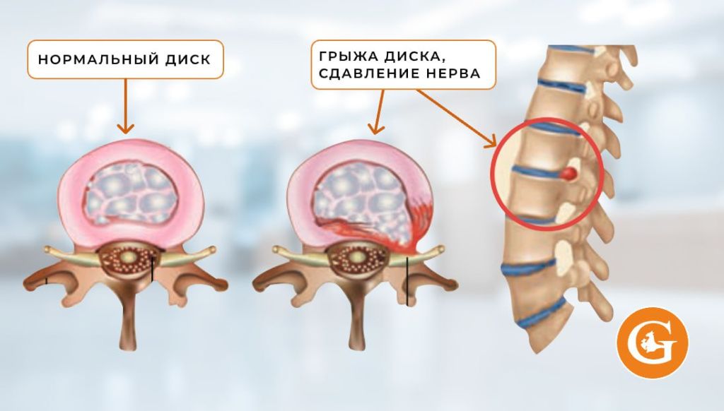 Микрохирургия грыжи